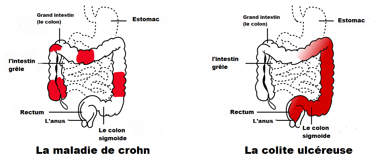 maladie de Crohn vs la colite ulcéreuse