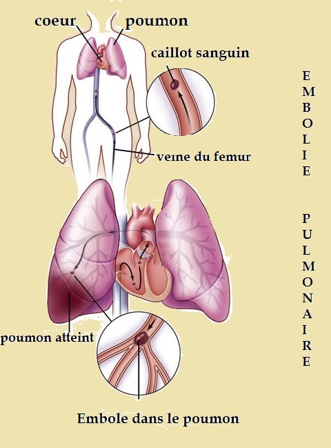 embolie pulmonaire- caillot dans la jambe qui se déplace vers les poumons