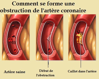 Infarctus du myocarde-caillot dans l'artère coronaire