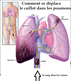 Embolie pulmonaire-Schema des poumons atteints