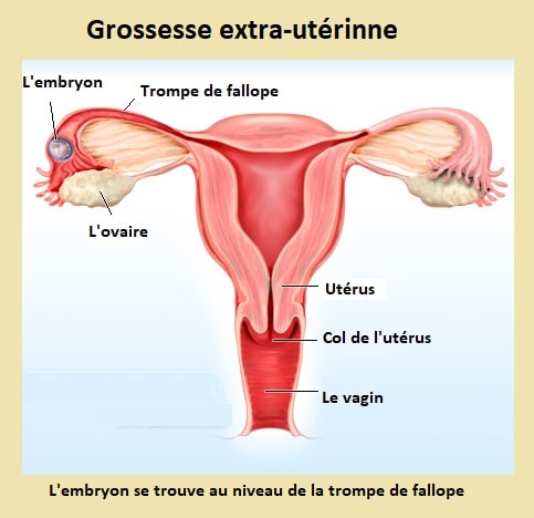 Grossesse extra-utérine- saignement vaginal pendant la grossesse