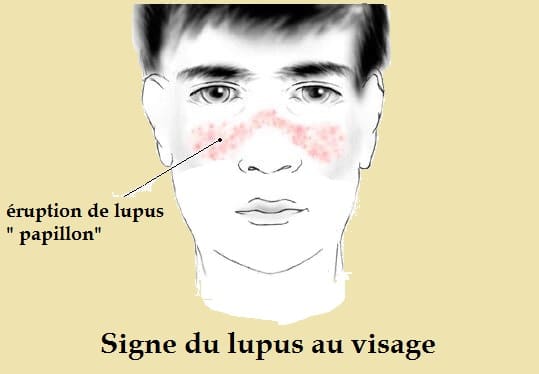 la maladie du lupus érythémateux