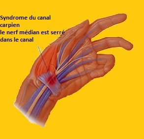 Syndrome du canal carpien- le nerf médian