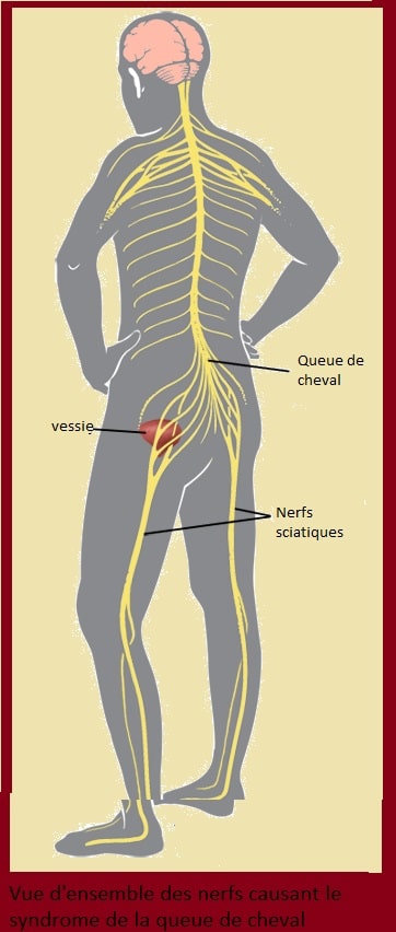 vue d'ensemble des nerfs causant le syndrome de la queue de cheval