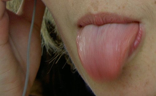 cancer de la langue- papillomavirus