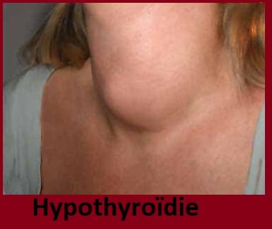 Hyperthyroïdie & hypothyroïdie